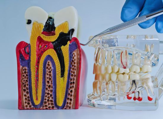 Imagem de dente antes e após tratamento de canal
