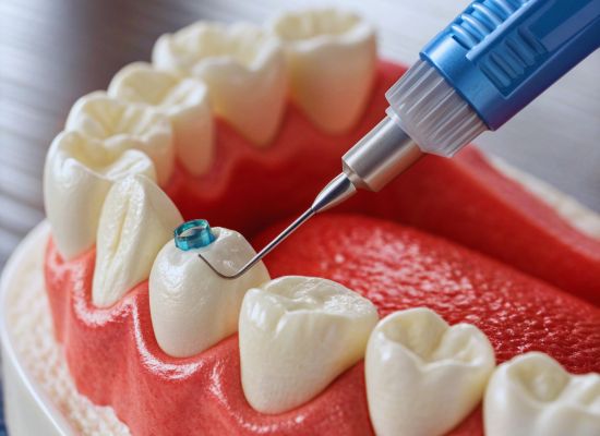 Dentista realizando procedimento endodôntico