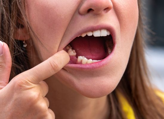 Dentista realizando procedimento de exodontia