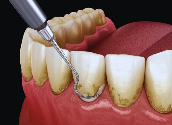 Dentista realizando procedimento periodontal