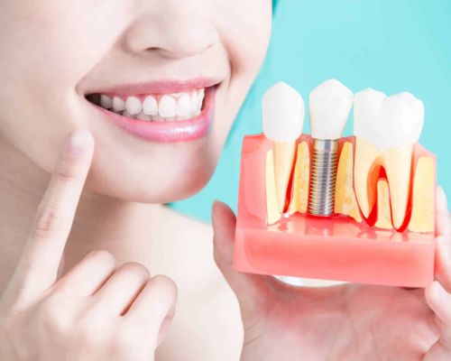 Imagem de paciente sorrindo após implante dentário