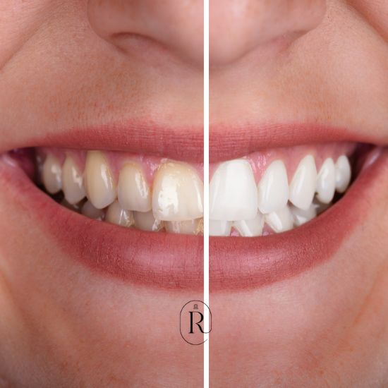 Clareamento dental profissional e seguro