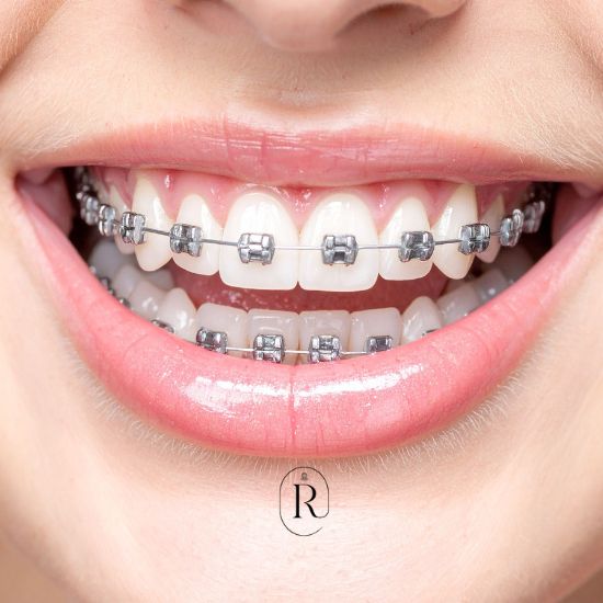 Ortodontia e aparelho dentário
